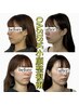 【圧倒的小顔】頬骨・エラ張り・お顔の脂肪に OASIS式小顔矯正