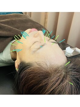 たんぽぽ整骨院鍼灸院/美容はり施術♪