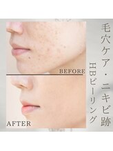 美バリ 新宿店(美BARI)/HBピーリング　3回