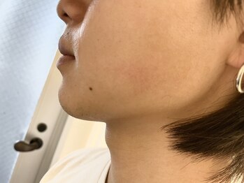 サロン ド アーミー(SALON DE ARMY)/顔脱毛