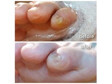 足裏・趾間・爪周囲、様々魚の目ケアは回数重ね除去いたします