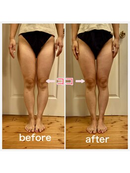 ナニ(nani)/リンパ+骨盤矯正+バンテージ