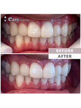 イージーホワイトニング 五反田店(easy whitening)/セルフホワイトニング症例写真