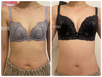 美人バスト 浜松店/◇ バストアップ &nbsp;BeforeAfter◇
