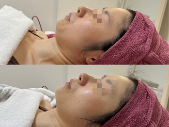 GRACETHOUSAND(グレイスサウザンド)/ハーブピーリング+ハイドラ洗浄