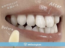 ホワイトニングカフェ 立川店(WhiteningCafe)/◎歯のホワイトニング施術写真◎