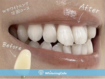 ホワイトニングカフェ 立川店(WhiteningCafe)/◎歯のホワイトニング施術写真◎