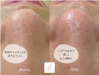 リル ビューティー ラボ(LILU BEAUTY LAB)の写真/韓国式毛穴洗浄×水光ハーブピーリングで毛穴悩みのないお肌に!毛穴の黒ずみ・詰まりを一掃&毛穴リセット◎