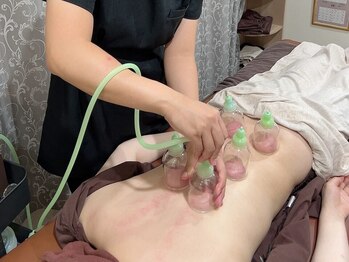 神門整体院 甲東園の写真/様々な体の不調を改善◎頑固でガチガチ筋肉や慢性疲労にはカッピングがオススメ！！