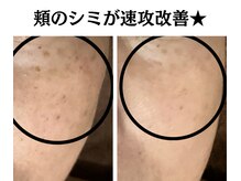グレースティー 森町 箕面/頬のシミが改善★
