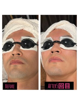 アオアクア(AOakua)/脱毛効果♪最先端脱毛器ルミクス