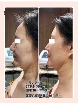 リファイン(REFINE)/小顔効果◎レモンボトル