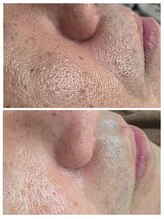 アンジェリーナ/毛穴洗浄/メンズ美容