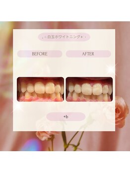 プラスビーセルフ(+b self)/ホワイトニングビフォーアフター