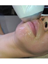 ケイカ(KEIKA)/口角の脱毛も見逃さない！