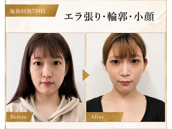 サロンチオリ 烏丸(Salon Chiori)の写真/エラ張り・顔幅・重いフェイスラインへ。食いしばりをゆるめ、土台から引き上げる大人の小顔矯正