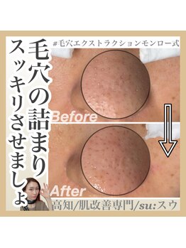 スー(su:)/毛穴悩みもお任せください！
