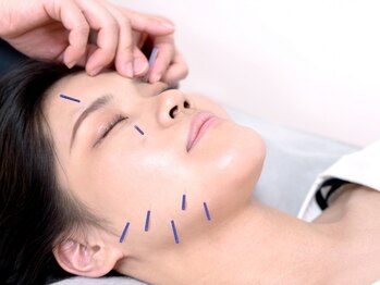 山本鍼灸整骨院 ユアエルム成田院/美容鍼で自然の力で美しいお肌へ