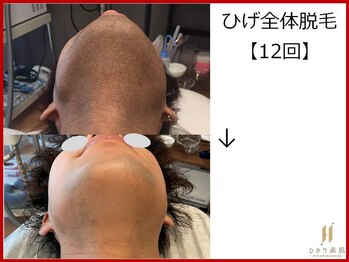 ひかり素肌/ひげ脱毛12回