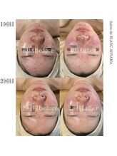 サロン ド ブラン アオヤマ(Salon de BLANC AOYAMA)/ニキビケアならお任せ