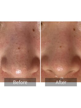 ヒヨリ(hiyori)/《before/after》毛穴洗浄