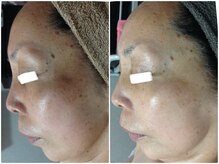 ルノン(LUNON)/ビフォーアフター集