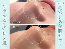 ネオファースト(NeoFirst)/つるんと毛穴レス肌