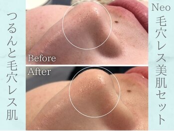 ネオファースト(NeoFirst)/つるんと毛穴レス肌