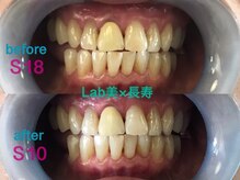 ラブ美長寿 沖縄本店(Lab)/ホワイトニングビフォーアフター