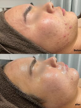 チェルト 鈴鹿店(CERTO)/結果重視のハーブピーリング