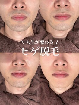 セレ(Cele)の写真/メンズ脱毛★ちょっと痛くても…圧倒的効果実感で人生が変わる！
