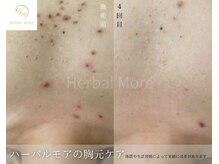 スキニティ 池袋(sknity)/<デコルテ>胸元の肌荒れケア