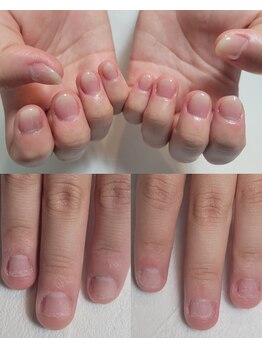 エムユーファイブネイル(MU5-nail)の写真/長年の悩みを解消しませんか？深爪矯正★長さだし技術で爪の悩みを解消します!甘皮・ささくれも綺麗に♪