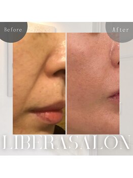 リベラサロン(LIBERA SALON)/たるみ、ほうれい線もスッキリ!