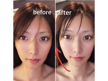 ブライダルエステ バイ スイスパ表参道(BRIDAL ESTHE by SUI SPA)/【小顔矯正】小顔 Before→After