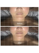 レグラージュ(Reglage)/１回の施術・Before＆After