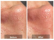 ステッラ(STELLA☆)/毛穴洗浄　Before/After