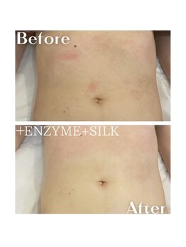 ヒーリングハーツ(Healing Hearts)/お腹の肌質改善!/清水町/