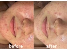 ホワイトアクア 鹿児島店(WHITE AQUA)/ハーブピーリング/赤み/肌荒れ