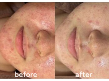 ホワイトアクア 鹿児島店(WHITE AQUA)/ハーブピーリング/赤み/肌荒れ