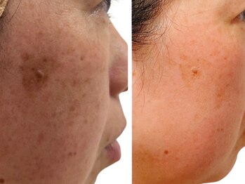 スローティ ラテ 旭川店/あらゆるお肌のお悩みを改善♪