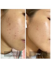 エルヴェ(Eleve)/長年のニキビのお悩み