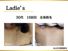 アルゴ 堺東駅前店(ALGO)/全身脱毛