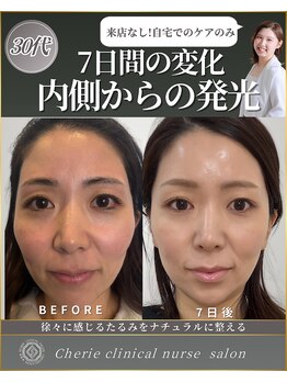 シェリー(Cherie)/【インセルダム】小顔たるみ7日
