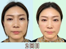 ナチュラルパーフェクトフェイス 新宿/2回目アンバランス改善/新宿小顔