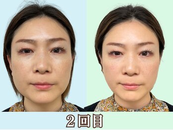 ナチュラルパーフェクトフェイス 新宿/2回目アンバランス改善/新宿小顔