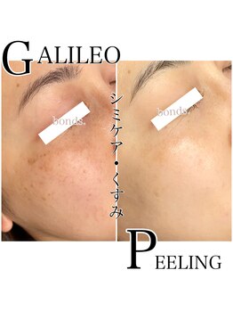 ボンズ(bonds.)/bondsで大人気!感動ピーリング