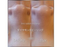 リノサロン モアナ(lino salon moana)の雰囲気（ダイヤモンドピーリングで艶肌＆小鼻周りのプツプツ改善/￥4,500）