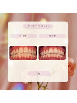 プラスビー 2号店(+b)/ホワイトニングビフォーアフター