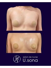 小顔・脂肪コントロール専門 salon de nurse U.sona～松本店～/【バストケア】脂肪増殖10cc
